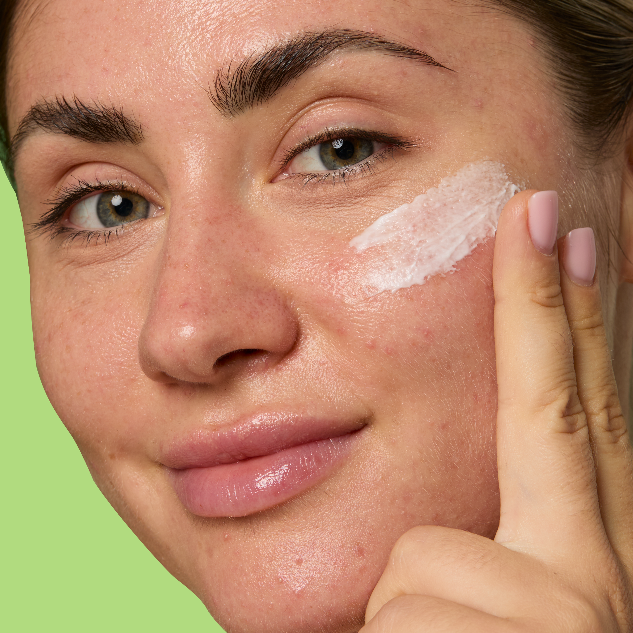 10% Azelaic Acid Treatment